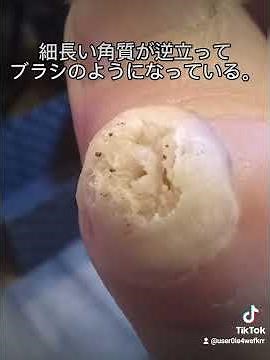 イボ治療。皮膚科で液体窒素治療。今ではかさぶたも無くなり完治しています。