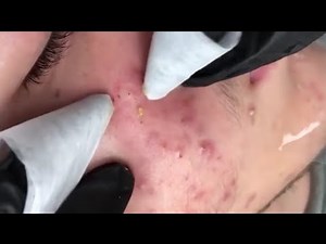 Treating Acne - Blackhead _ Blackhead Removal on forehead || Remove Blackhead