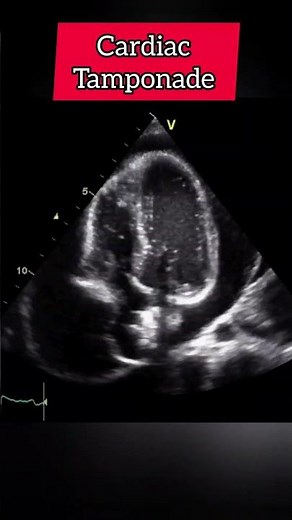 Cardiac Tamponade