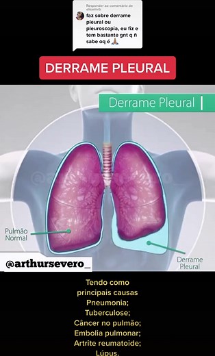 Entenda o Derrame Pleural: Causas e Sintomas