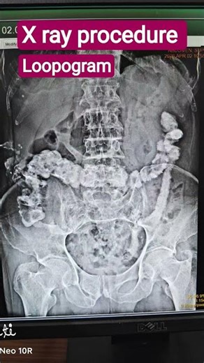 X ray procedure Loopogram #anatomy #pathology #viral