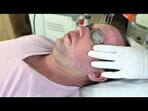 Acne scar treatment with CO2 Laser