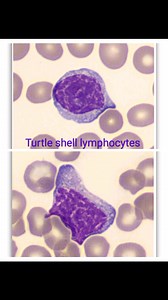 🐢 Turtle shell Lymphocytes (also referred to as “Tortoise shell” or “Soccer ball” appearance) 🐢 🐢 Lymphocytes characterized by an abnormal nuclear morphology. ✅ Nucleus: Shows very coarse and densely clumped chromatin, forming alternating pale spaces and thick chromatin strands within the nucleus ✅ Characteristic pattern: The chromatin distribution creates a distinctive pattern resembling a turtle shell or a soccer ball ✅ Cytoplasm: Usually scant 💐The presence of Turtle shell Lymphocytes is 