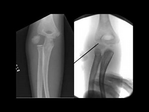 Percutaneous Screw Fixation of Lateral Condylar Humeral Fractures