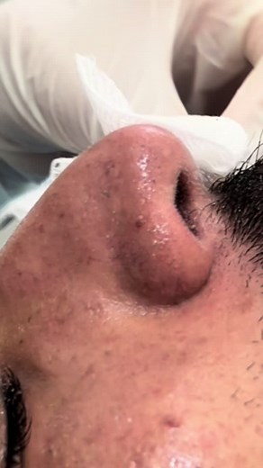 Nose Treatment: Professional Extraction for Clear Skin