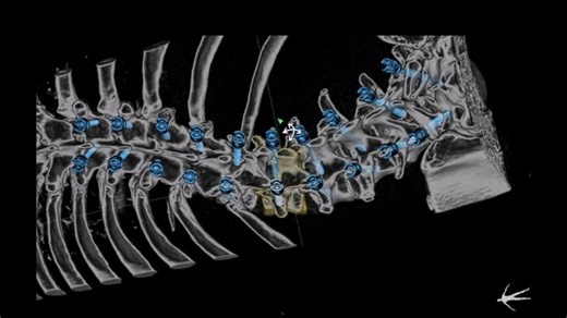 Navient AI-Powered Spine Planning | ClaroNav Kolahi Inc