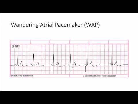 wandering atrial pacemaker