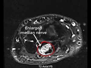 Enlarged Median Nerve on Wrist MRI
