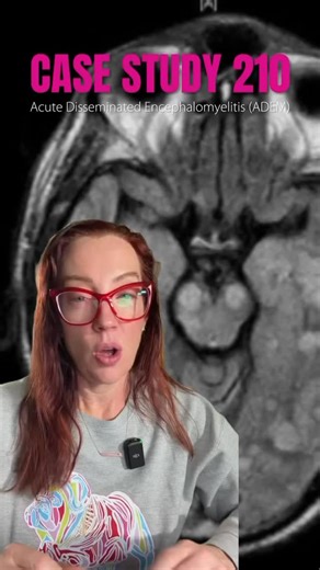 Betsy Grunch, MD | Neurosurgeon on Instagram: "Case Study 210 | ADEM This case highlights Acute Disseminated Encephalomyelitis (ADEM) - a rare, immune-mediated inflammatory condition that primarily affects the brain and spinal cord, most often in children and young adults. ADEM typically follows a viral infection or vaccination, when the immune system mistakenly attacks myelin, the protective coating around nerves. The result can be sudden neurologic symptoms like weakness, difficulty walking, v