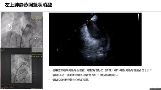 ICE在FARAPULSE手术中的应用
