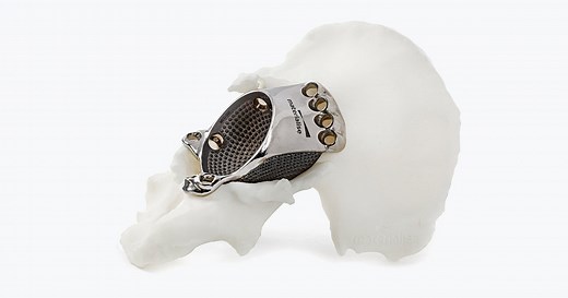 Materialise aMace | Personalized Acetabular Implants