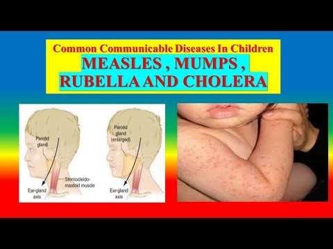 Common Communicable Diseases In Children - MEASLES , MUMPS , RUBELLA AND CHOLERA