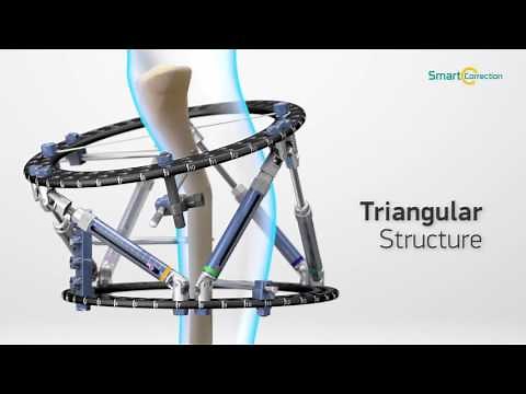 Smart Fixator® - Smart Correction Hexapod Fixator