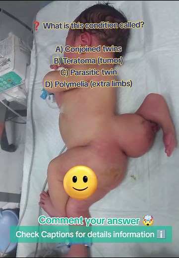 Understanding Parasitic Twins: A Rare Medical Condition