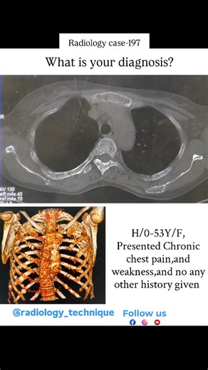 2.7K views · 32 reactions | Radiology case-197 A 53 year female Patient presented chronic chest and full body pain with weakness.. No any previous examination done.. Chest CT done and showing multiple cystic lesion.. What is your diagnosis ? #viralreels #reels #medicos #medico #mbbs #mbbsstudent #radiología #radiology #radiologia #medicos #médicos #pulmonary #bone #bonedisorder #fby #fbreels #fb | Diwakar Patel | Facebook
