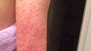 Images show eight types of rash that could be symptom of coronavirus