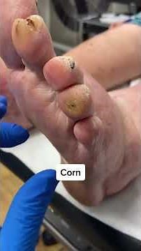 Experience the ultimate satisfaction! Watch this toe-tastic corn removal journey now!