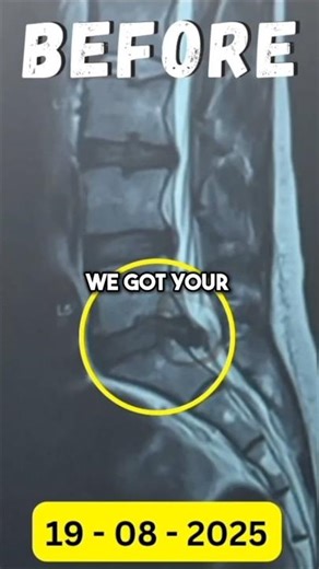 L5–S1 DISC EXTRUSION → FULL RECOVERY WITHOUT SURGERY ##discextrusion