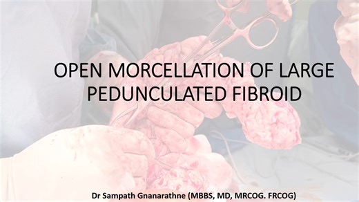 Open Morcellation