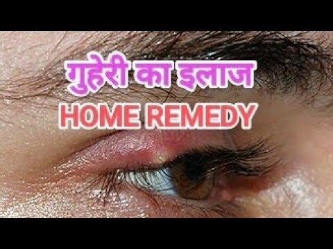 गुहेरी का इलाज Home Remedy |