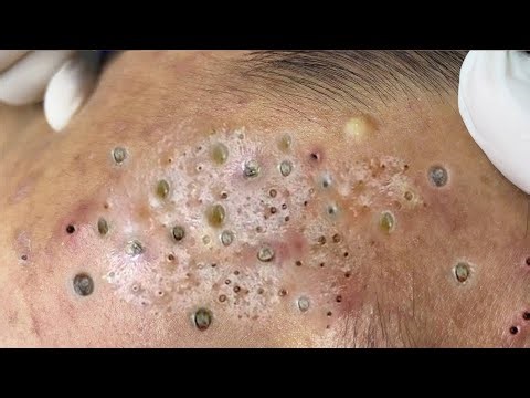 Deep Blackhead Removal – Real Acne Extraction for Relaxing Skincare Satisfaction Music - 987693