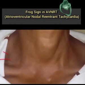 57K views · 358 reactions | The frog sign in AVNRT (Atrioventricular...