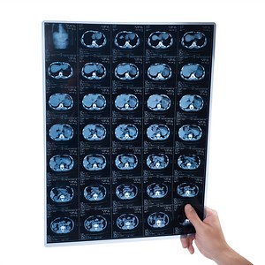 [Hot Item] 14X17 Medical X-ray Film Compatible with Fujifilm Drypix Lite 2000