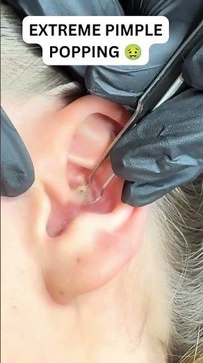 EXTREME PIMPLE POPPING 🤢
