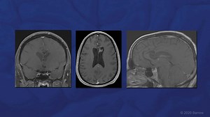 Resection of Callosal AVM and Clipping of Contralateral Pericallosal Artery Aneurysm - About the Surgeon and Procedure - Live Surgery and Chat with Dr. Spetzler