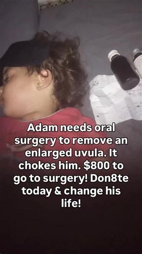 LonestarCaritas on Instagram: "🚨 LIFE CHANGING SURGERY NEEDED! 2 year old Adam has an enlarged uvula that requires surgery. He requires medication to reduce the swelling to be able to eat and drink. He needs $800 more to afford the surgery. That’s 40 people giving $20. 40 people skipping their lunch out. Will you help? Give at link in family’s bio. ➡️ @genentamer 🔗 #toystory #friendinme #msrachel #arianagrande #billieeilish #selenagomez #traviskelce #oralsurgery #surgery #gofundme #ent #earnos