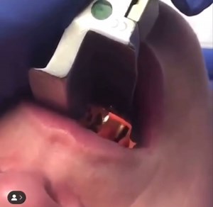 368K views · 1.4K reactions | Visualization of vocal cords during intubation. #ambulance #airway #vitalshotslv #paramedicsonfacebook | Paramedics on Facebook | Facebook