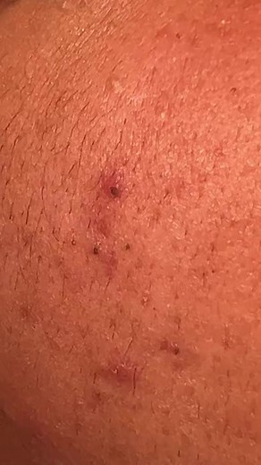 #pimplepop #pimplepopperaddict #blackheadextraction #pimplepopper2023 #foryoupage #blackheads #paratipage #blackheadremoval #pimplepoppingheaven