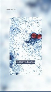 Cyclospora symptoms: Doctor explains diagnosis and treatment