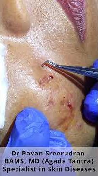 Calcinosis Cutis on the Cheek–Stone from face Removal Procedure | മുഖത്ത് നിന്ന് കല്ല് നീക്കം ചെയ്യൽ