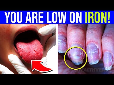 12 WARNING Signs Your Body Is LOW On Iron (Iron Deficiency Anemia)