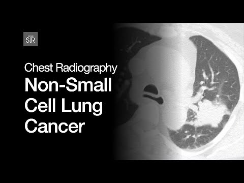 Chest Radiography: Non-Small Cell Lung Cancer