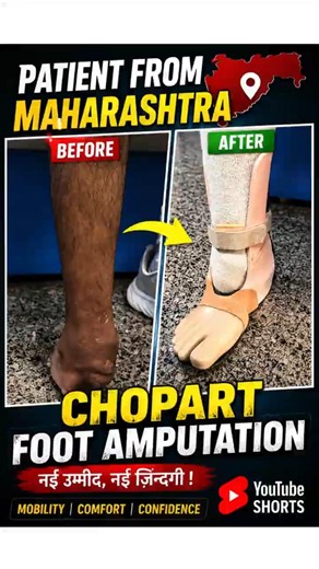 🦶Partial Foot Prosthesis | Chopart Foot Amputation | Best Artificial Limbs Clinic in India #ampute