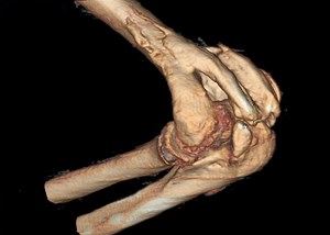 When Bone Grows Beyond the Elbow Skeleton: Heterotopic Ossification, Why Does it Matter and How to Deal with It - Shoulder & Elbow