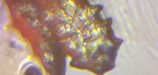 Demodex Death by Intense Pulsed Light by Laura Periman, MD