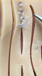 Locking vertical mattress stitch | Dermhacks