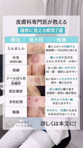 湿疹に見えるけど実は〇〇！？ #上野御徒町ファラド皮膚科