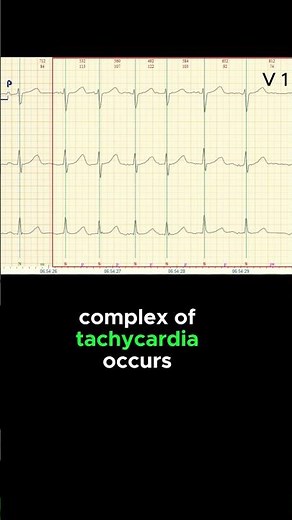 FOCAL ATRIAL TACHYCARDIA ECG EXAMPLE
