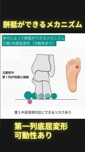 歩行によって胼胝ができるメカニズム⑤第一列底屈変形（可動性あり） #理学療法 #ptタイガー #日本足病学協会 #足病学