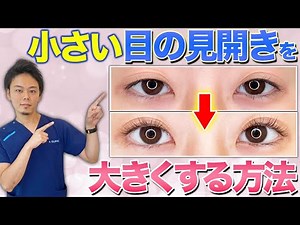 【整形】医師が教える！目の見開きを良くする方法！
