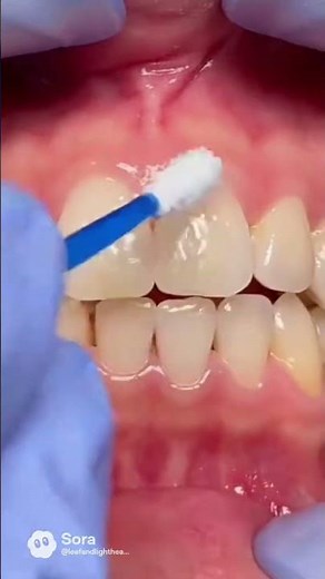 Braces Placement in 10 Seconds | Step-by-Step Orthodontic Procedure #shortvideo