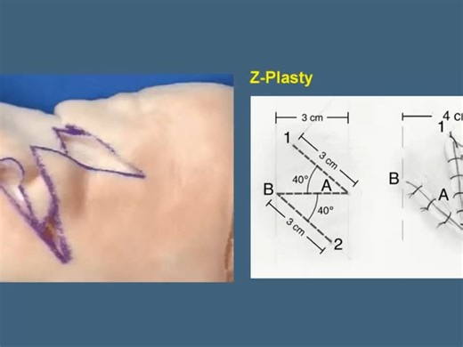8. 4. Z-Plasty- Skin Flaps - Essential Surgical Skills