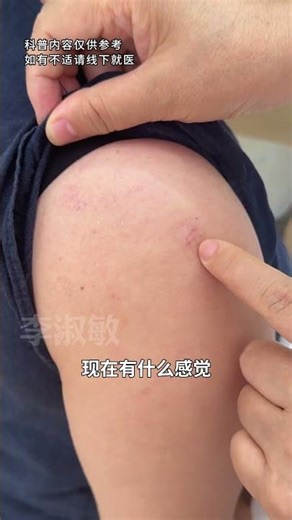 肩膀疤痕疙瘩，保守治疗一次上岸💪#Scar #ScarRemoval #Keloid #KeloidScar #HypertrophicScar #HypertrophicScarTissue
