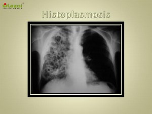 Histoplasmosis (fungal infection of the lungs): Symptoms, causes and treatment - SlideServe
