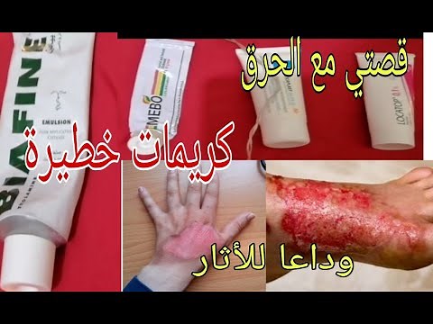 أفضل كريم لإزالة أثار الحروق والجروح والندوب مع طرق العلاج