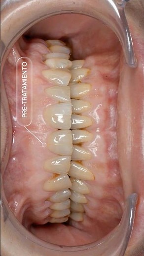 CARILLAS dentales: ¿cómo funcionan? Así se transforma una sonrisa con #carillas #carillasdentales